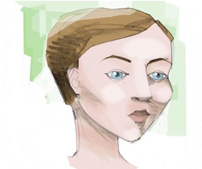 Illustratie van een vrouw met een voorhoofdslift behandeling in Middelburg bij MedCentric